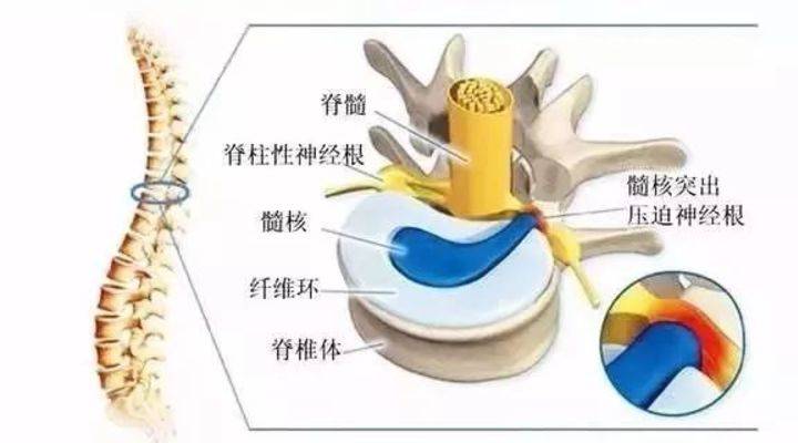 11月2日根線蟲最新根治法詳解，有效治療根線蟲的方法與解析