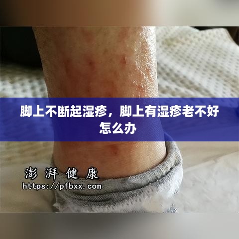 腳上不斷起濕疹，腳上有濕疹老不好怎么辦 